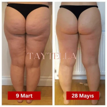 3'lü Etki Taytı Lipödem, Selülit, Varis Marlavé™
